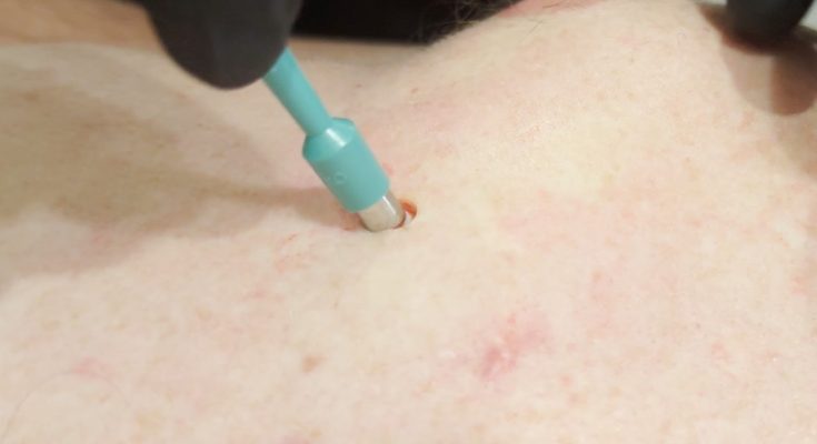 CHEST CYST!