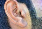 blackheads elderly in ear👂