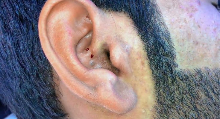blackheads elderly in ear👂