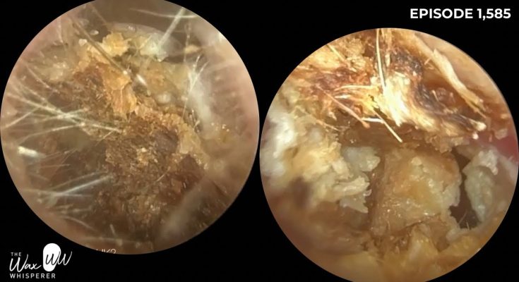 Third Time Lucky Ear Wax Removal