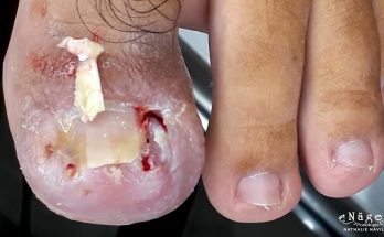 SHOCKING SCENES | DEEP AND TRAUMATED NAIL