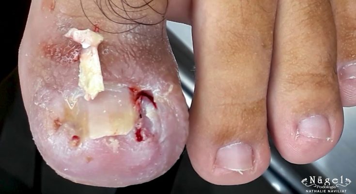 SHOCKING SCENES | DEEP AND TRAUMATED NAIL