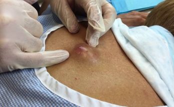 Infected Cyst Removal on the Mid-Back