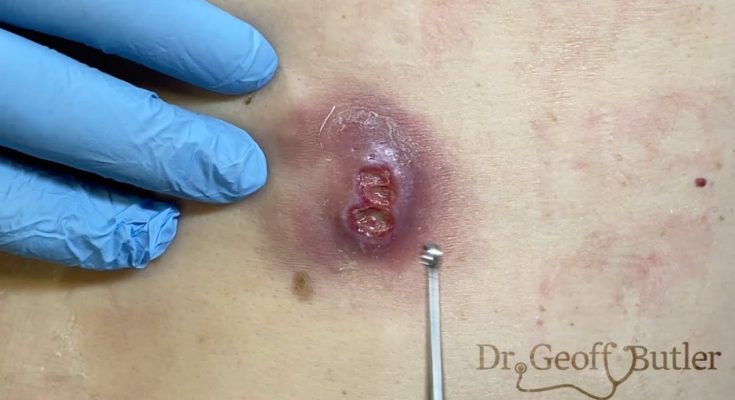 Drainage of an infected cyst in front of the ear
