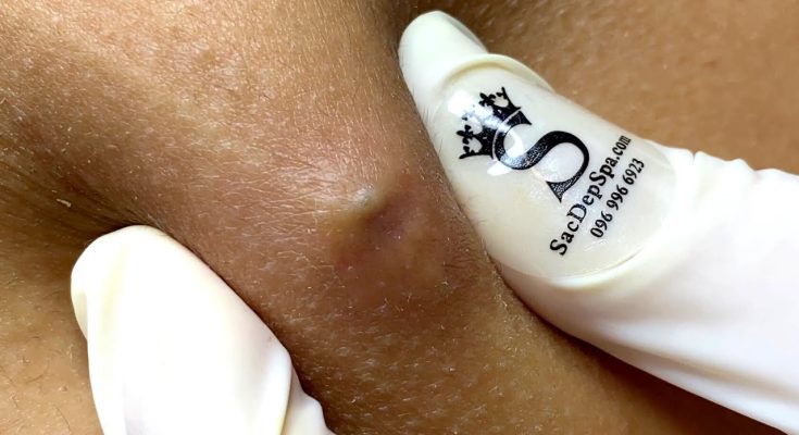 Amazing Remove Blackheads watch…