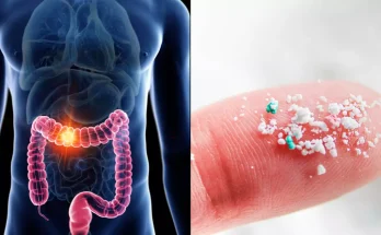 Scientists believe they have uncovered major cause of specific cancer that has cases rising among young people