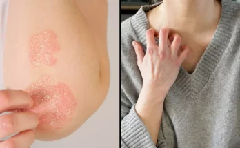 Doctor warns ‘invisible disease’ that half a million Brits have may be caused by scaly skin condition