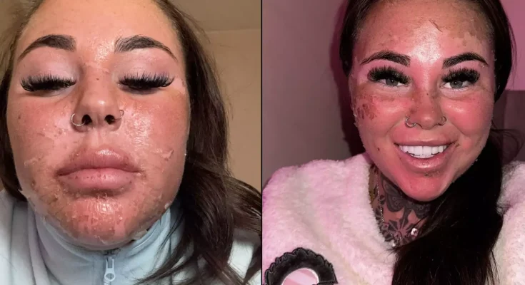Influencer left horrified after accidentally burning skin off face while attempting ‘dangerous’ sunbed hack