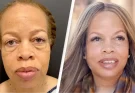 Woman had an entire face rejuvenation and the before and after results are insane