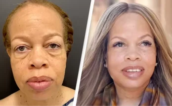 Woman had an entire face rejuvenation and the before and after results are insane