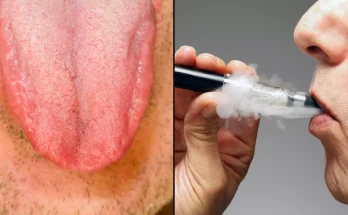 Expert reveals shocking long-term side effect of ‘Vaper’s Tongue’ that will put many people off