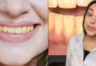 Dentist explains reason your teeth are yellow even though you 'always brush them'