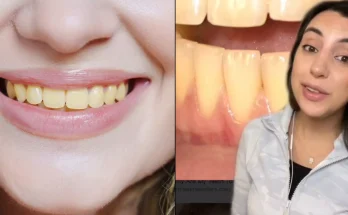 Dentist explains reason your teeth are yellow even though you 'always brush them'