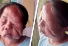 Woman whose face is 'melting off' her head speaks out about living with the condition