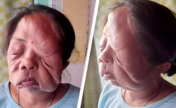 Woman whose face is 'melting off' her head speaks out about living with the condition