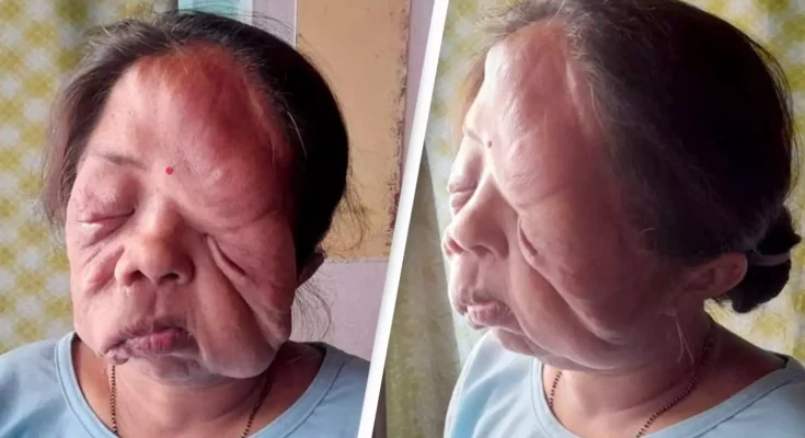 Woman whose face is 'melting off' her head speaks out about living with the condition