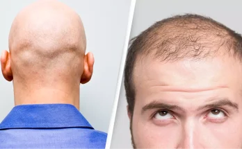 Important reason why men are far more likely to go bald than women