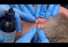 Removal of a Squamous Cell Cancer from behind the Ear