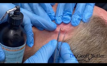 Removal of a Squamous Cell Cancer from behind the Ear