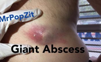 Drainage of an arm abscess