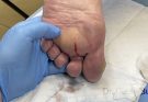 Unexpected drainage of an abscess on the foot