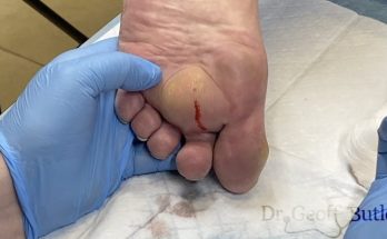 Unexpected drainage of an abscess on the foot