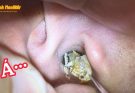 asmr- Earwax cleaning