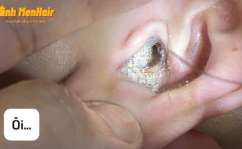 How to get earwax out of your ear