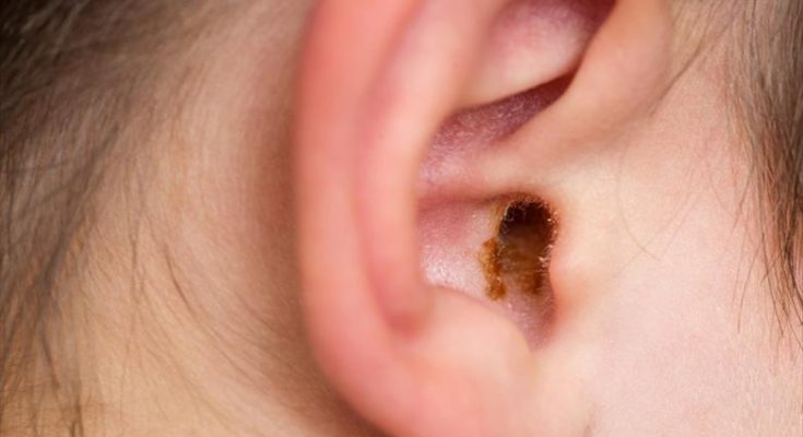 Epic Ear Wax Extraction: David vs. Goliath (Tiny Canal Edition!)