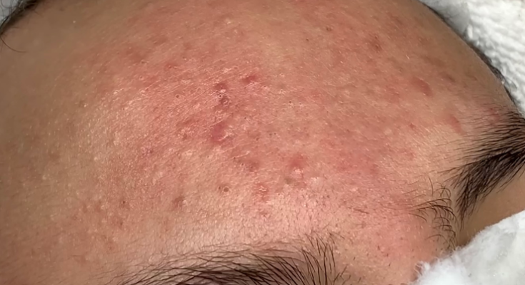 Inflammatory acne, yellow acne, blackheads – Acne Treatments Mai Ngoc 💕💕💕