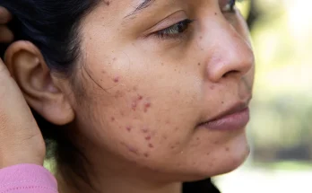 25 Causes of Raised Skin Bumps ( Pictures & Videos)