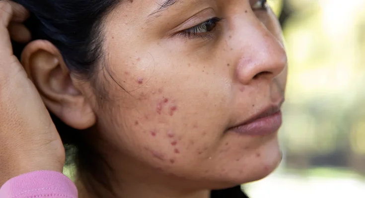 25 Causes of Raised Skin Bumps ( Pictures & Videos)