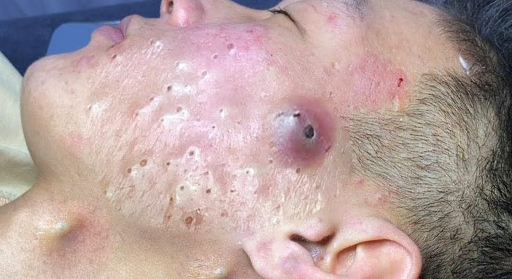 Is There a Safe Way to Pop a Pimple? A Dermatologist Weighs In