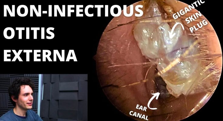 Non-Infectious Otitis Externa Underneath Dead Skin Plug (Acetic Acid Discussed)