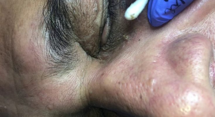 Old Eye Blackheads