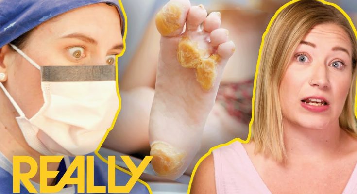 Ultra-Rare Condition With No Cure Treated With Revolutionary New Surgery | My Feet Are Killing Me