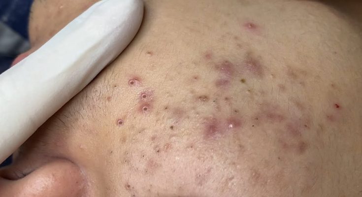 8 Ways to Remove Blackheads