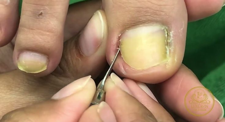 Ingrown Nail Tools [ Relaxing Cleaning Nail ] #usa #video #viralvideo