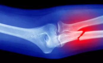 Eerie conspiracy theory you might want to pay attention to if you’ve never broken a bone in your life