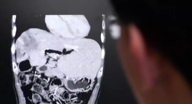 X-ray shows why single bite of popular Thai dish can give you liver cancer