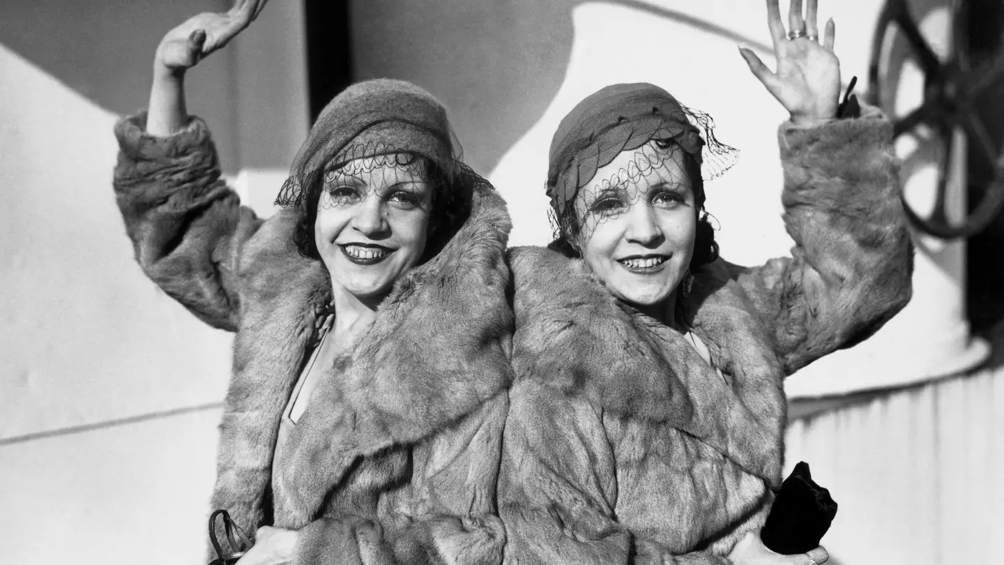 Tragic case of conjoined twin who had to live with dead sister attached to her