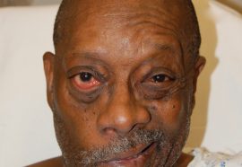 Stroke Warning Signs for Seniors Discussed