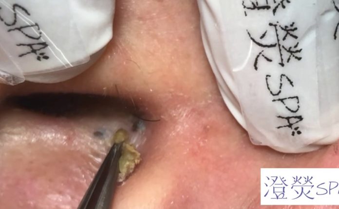 Blackheads: What They Look Like, Treatment & Prevention