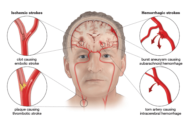 10 Warning Signs of Stroke One Month Before