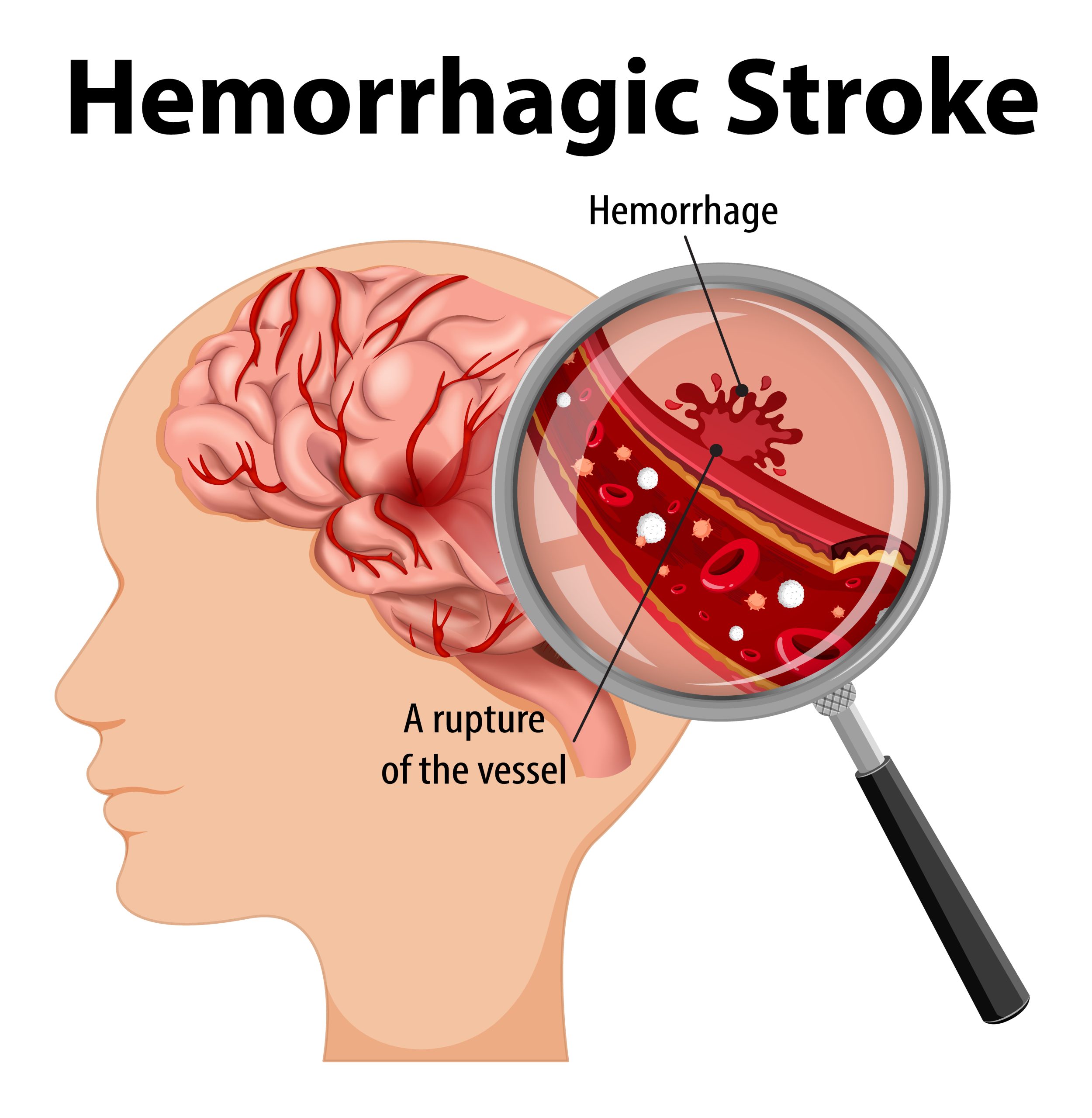 Understanding Brain Stroke: Symptoms, Causes, and Treatment