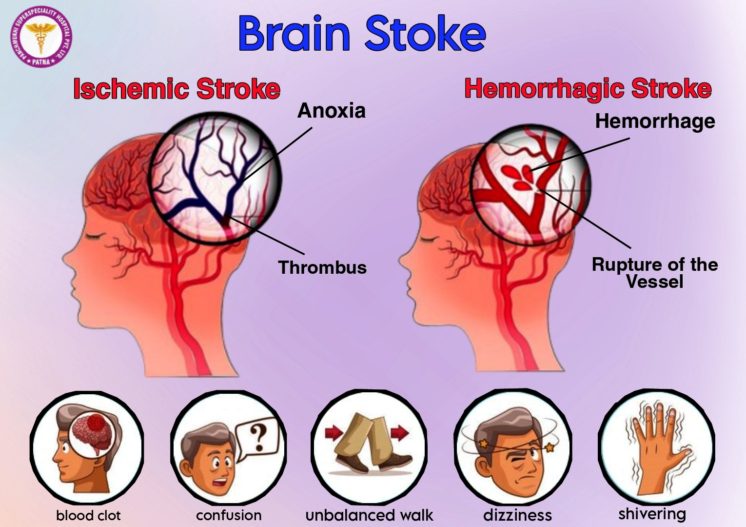 Brain Stroke is a Life life-Threatening Ailment that can be Cured if Treated on Time