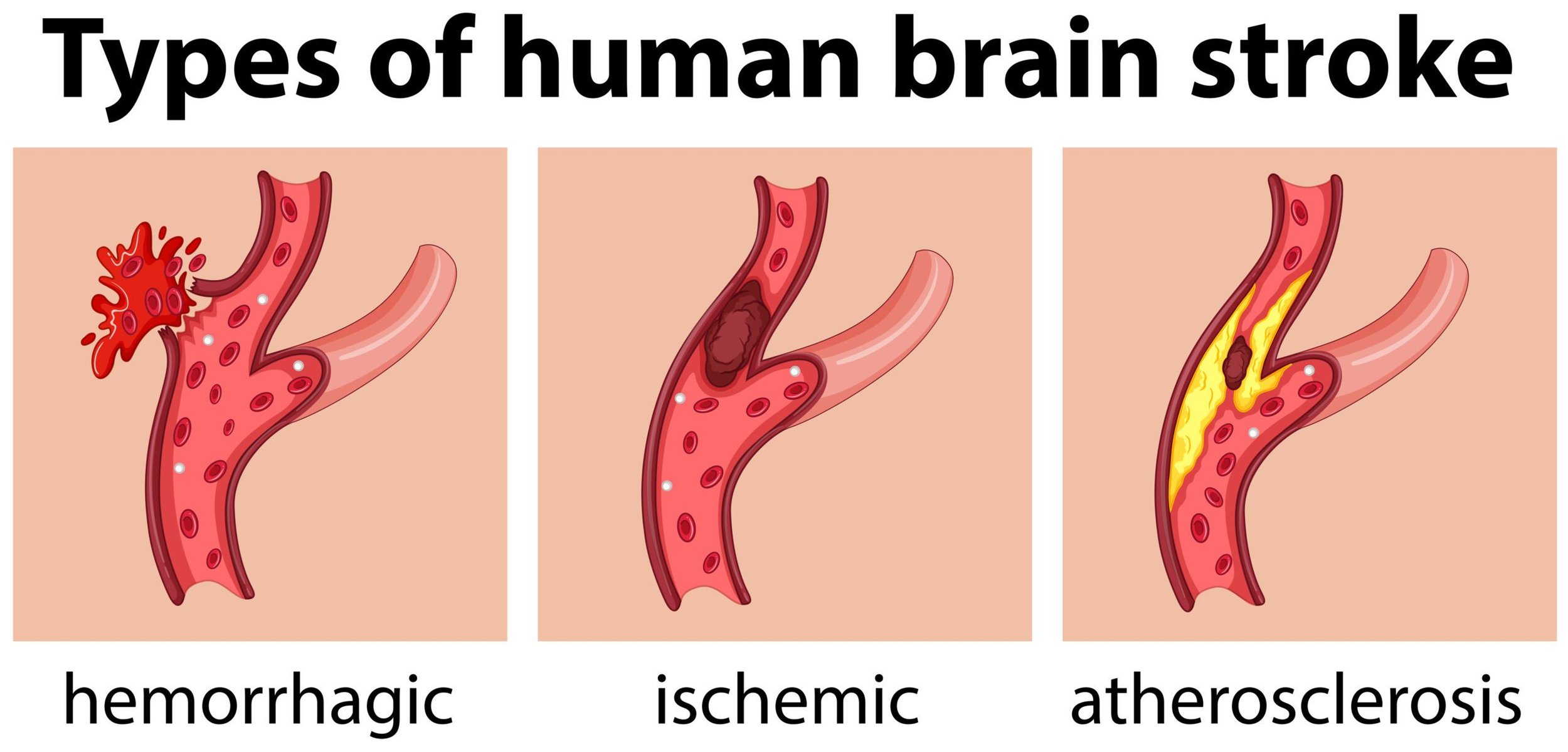 Stroke | The Foundation to Advance Vascular Cures