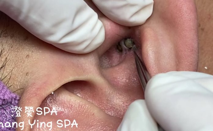 12 Ways to Get Rid of Blackheads