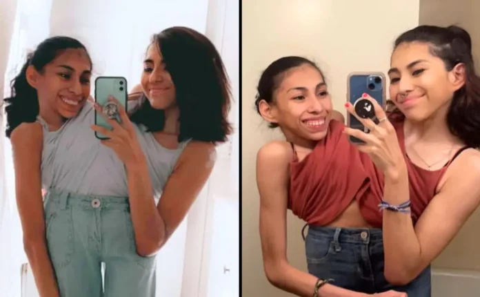 Conjoined Twin Carmen Andrade Is Now Married