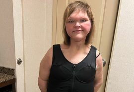 1000-Lb. Sisters’ Tammy Slaton Barely Recognizable After Showing Off Skin Removal Surgery Results